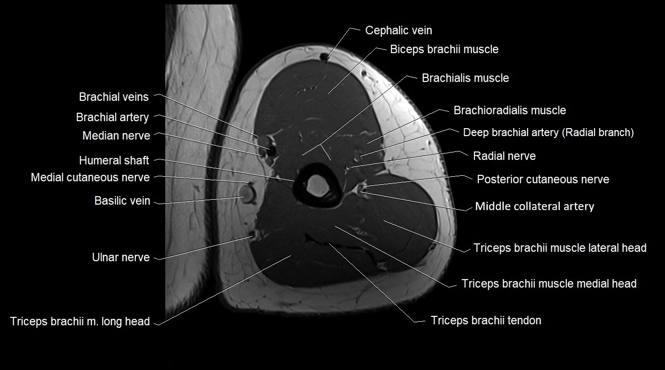 Upper arm( humerus) cross section anatomy MRI 3T axial image 42.webp